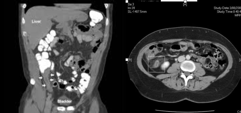 <p><em>CT Abdomen/Pelvis IV contrast</em></p>
