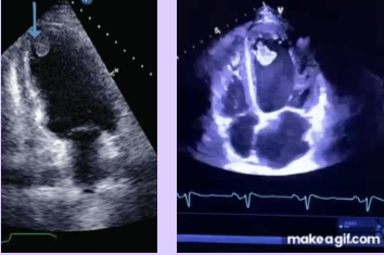 <p>Most common form of intracardiac thrombus due to impaired LV function.</p><p>Rarely occur in patients with preserved LV function.</p><p>Commonly found in the apex.</p><p>High risk for thromboembolic events, particularly stroke.</p>
