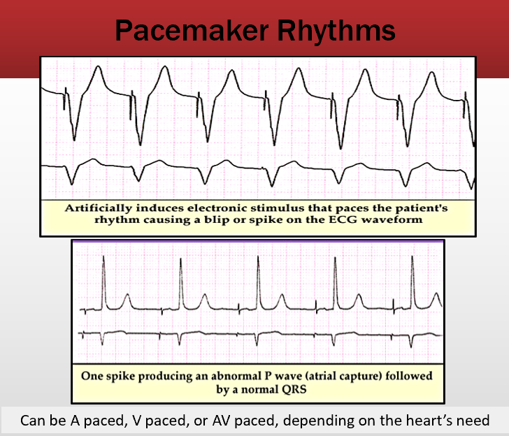 <p>, A is before the p wave V paced is after P wave</p>