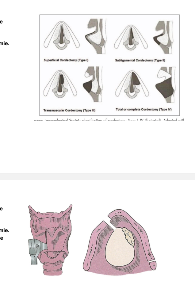 <p>Goede prognose <br>(T1>90% 5j)<br>Radiotherapie<br>Laser cordectomie. → via mond stukjes tumor wegnemen</p><p>Verticale partiële <br>laryngectomie</p><p>geen mucosale golf meer = tumor tot spier → met laser&nbsp;</p>