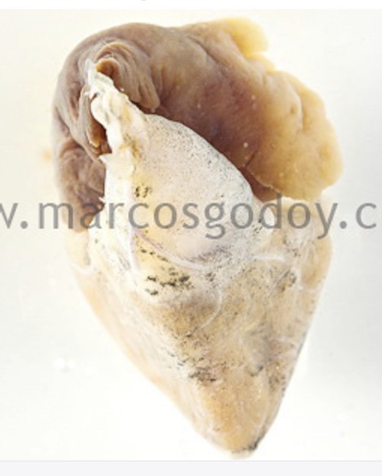 <p>pericardial diseases- melanosis causes</p>