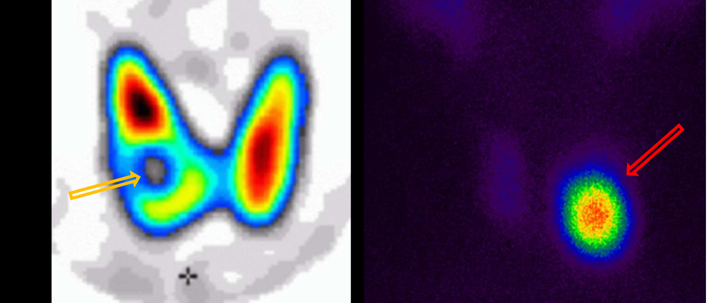 <p>Patient history: thyroid masses found on routine ultrasonography</p><p>Modality: thyroid gland scintigram, Technetium-99m (99m Tc)-pertechnetate scintigraphy </p><p>Region: thyroid </p><p>Radiologic sign: left image - Focal lesion showing decreased tracer activity in the right lobe (yellow arrow); right image - increased uptake in the left lobe of the thyroid, low uptake in other parts of the gland (red arrow).</p><p> Diagnosis: left – cold nodule, which arise the suspicion of malignancy; right – hot, most probably benign nodule causing suppression of normal gland function</p>