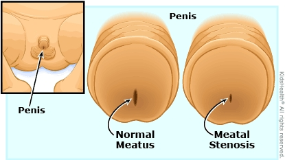 <p>The opening at the end of the urethra</p>
