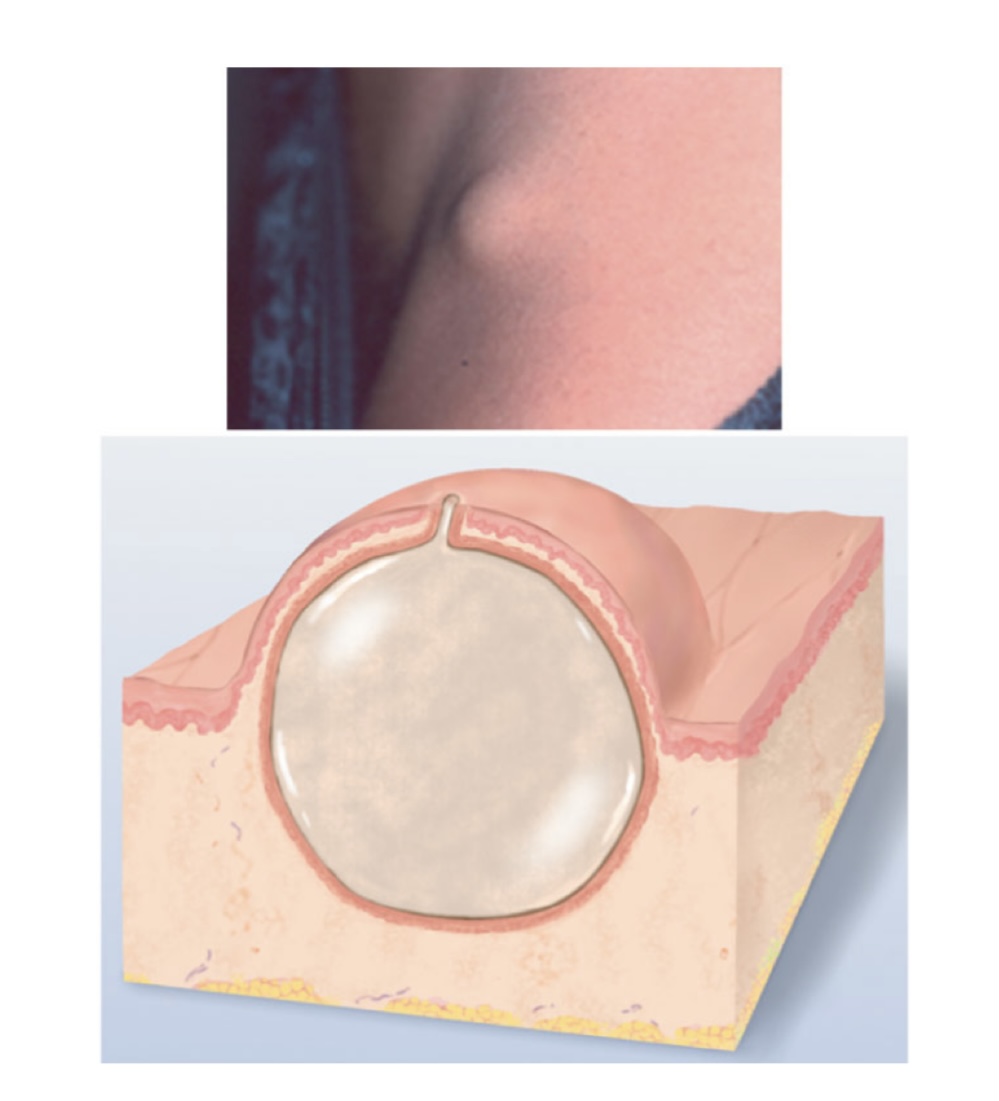 <p>Encapsulated fluid-filled cavity in dermis/ subcutaneous layer</p>