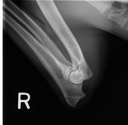 <p>what radiographic view of the elbow is shown?</p>