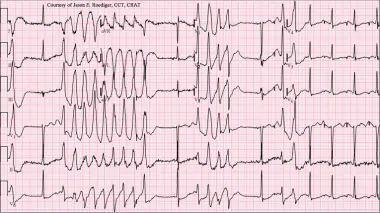 <p>What rhythm resembles a turning about or twisting motion along the baseline (isoelectric line)?</p>