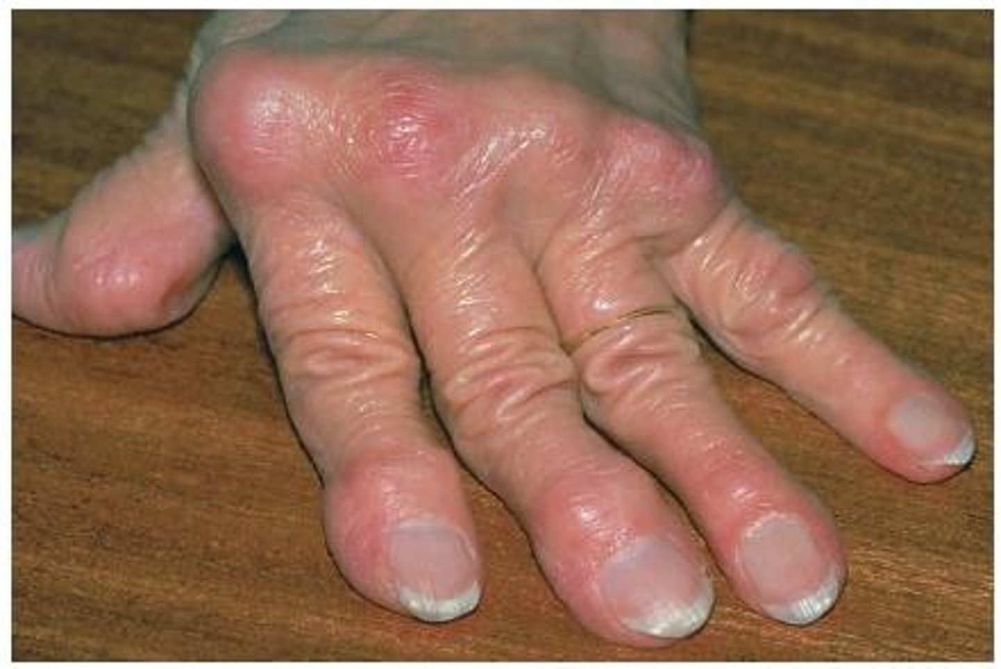 <p>swelling, knot</p>