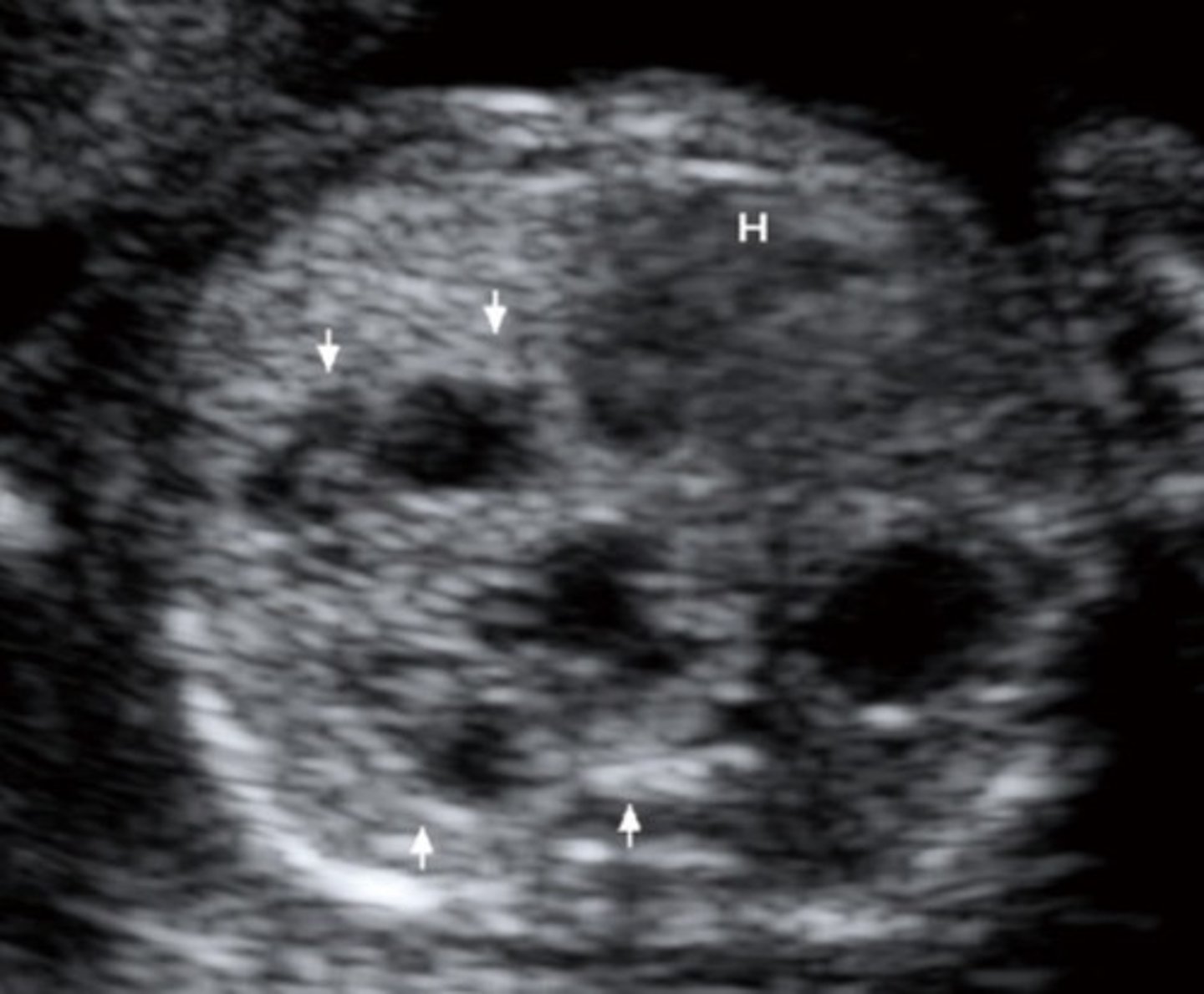 <p>Multiple smaller cysts within echogenic lung</p><p>Poorer prognosis</p>