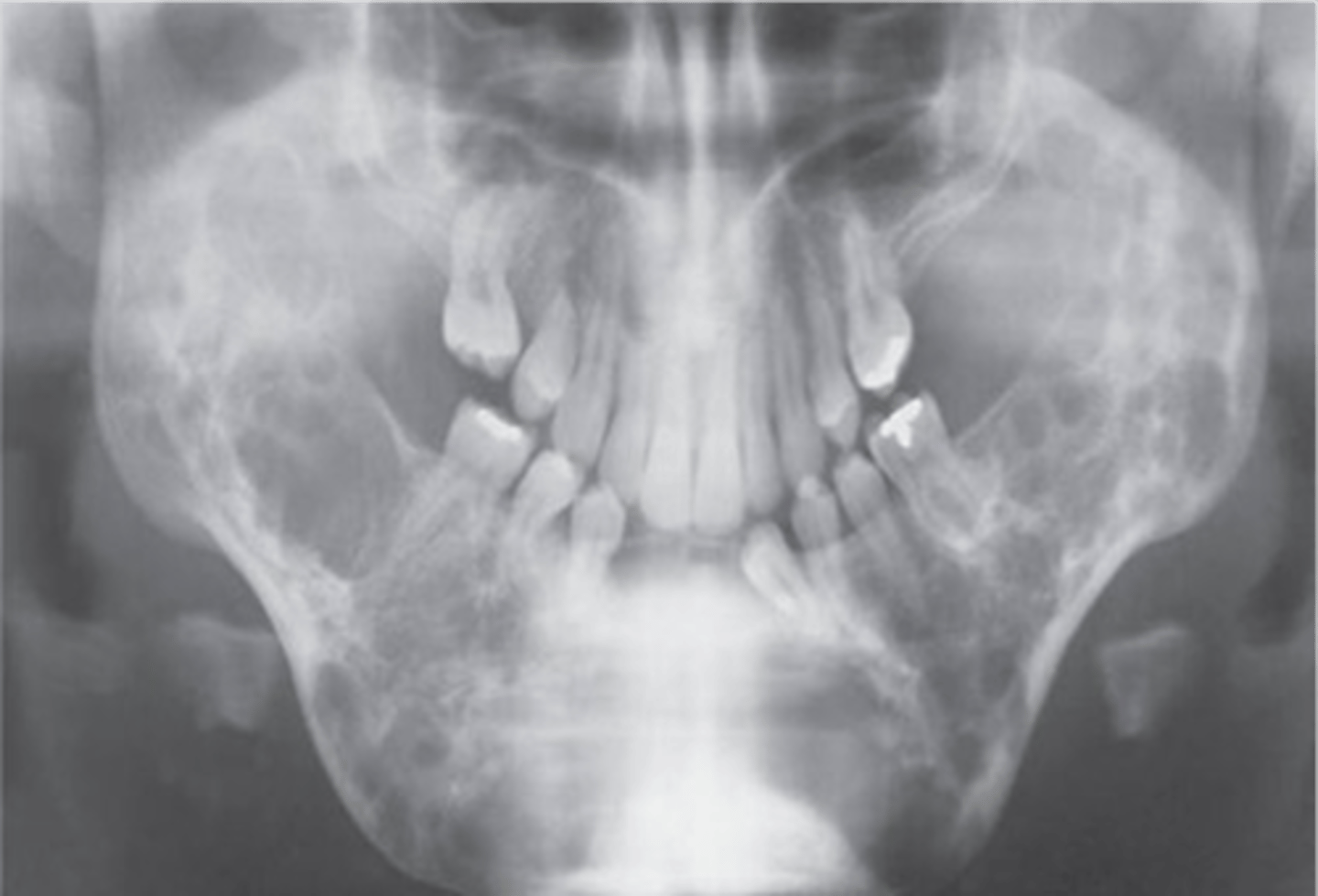 <p>-progressive bilateral facial swelling at 1-4 years of age, most commonly involves the mandible</p><p>-increased distance between eyes</p><p>-"soap bubble" appearance</p><p>-pseudodontia</p>