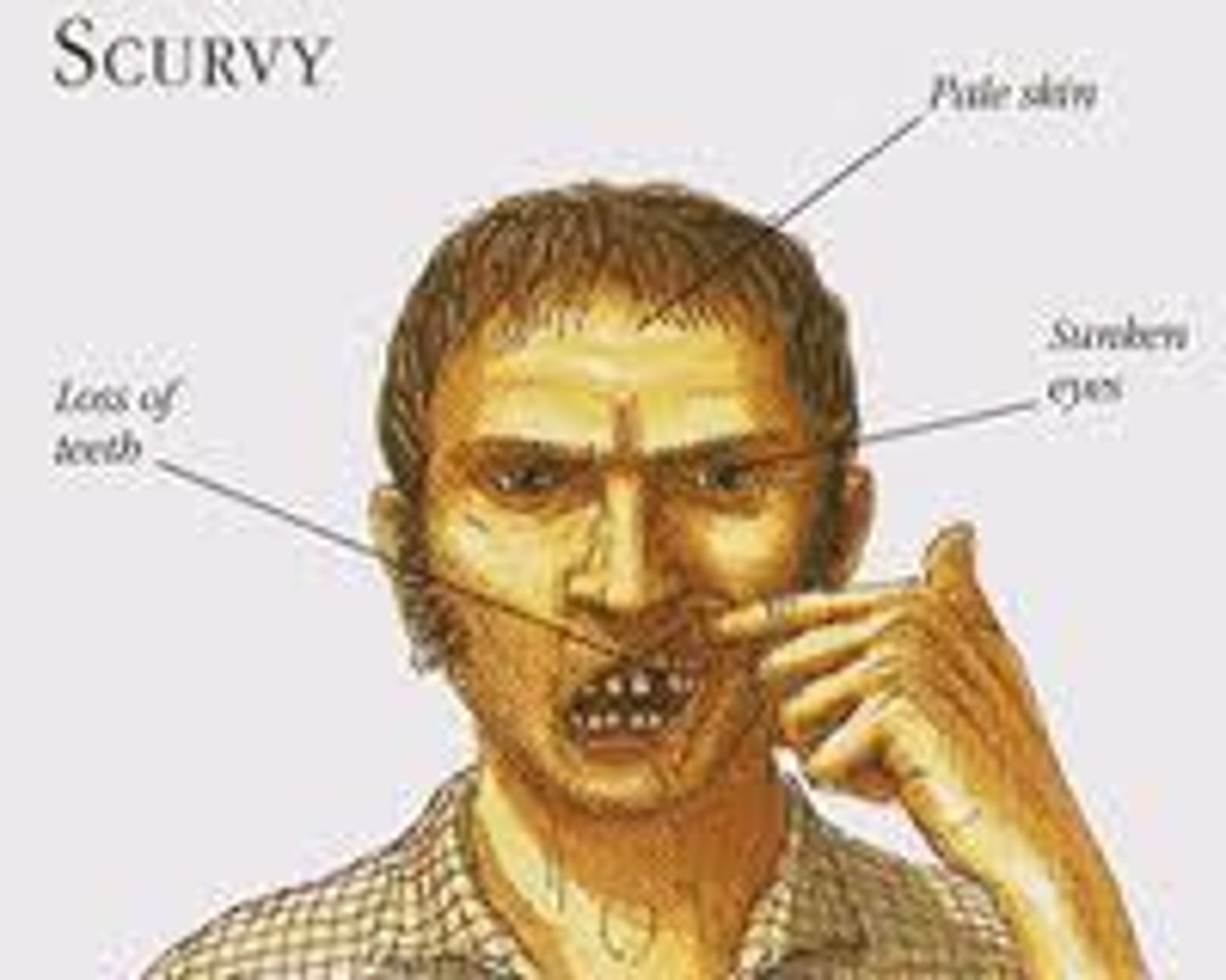 <p>Scurvy (vitamin C deficiency: can't hydroxylate proline/lysine for collagen synthesis)</p><p>Ascorbic Acid</p>