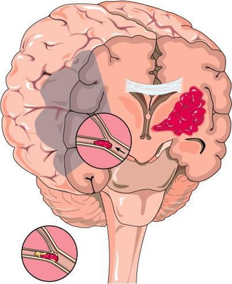 <p>Bleeding within the brain tissue.</p>