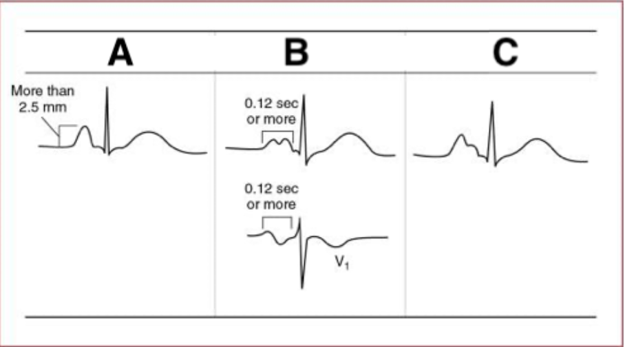 <p>A. RAA</p><p>B. LAA</p><p>C. Combined atrial abnormality </p>