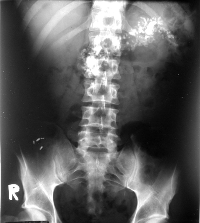 <p>horizontal at the L1-L2 level (CT scan more sensitive than abdominal film)</p>