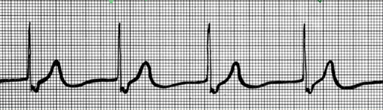 <ul><li><p>absence of P wave</p></li><li><p>&quot;junctional rhythm&quot;</p></li><li><p>Av node acting as primary pacemaker</p></li></ul>