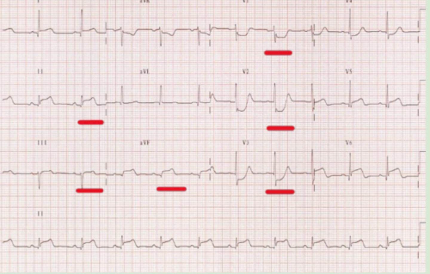 <p>ST elevation in leads II, III, aVF + ST depression in leads V1-V3</p>