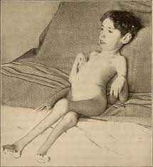 This is the permanent tightening of the muscles, tendons, skin, and nearby tissues that causes them to become stiff