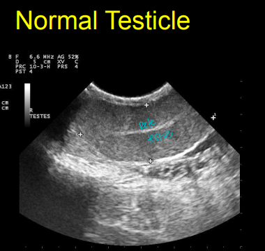 <p>Normal male reproductive tract on Ultrasound</p>