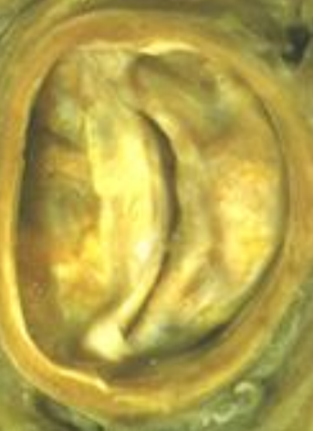 <p>When there are only two leaflets of the aortic valve (there should be three).</p>