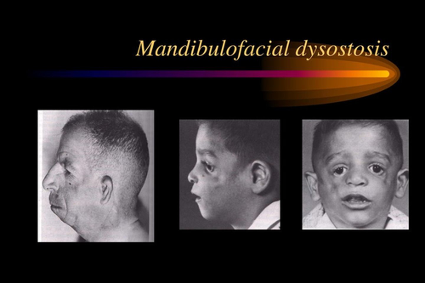 <p>Defective ossification</p>