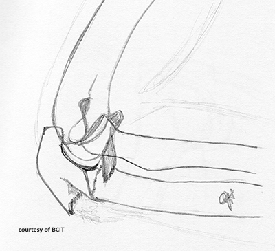 <p>Fall on flexed elbow; triceps muscle pulls fragment proximally.</p>