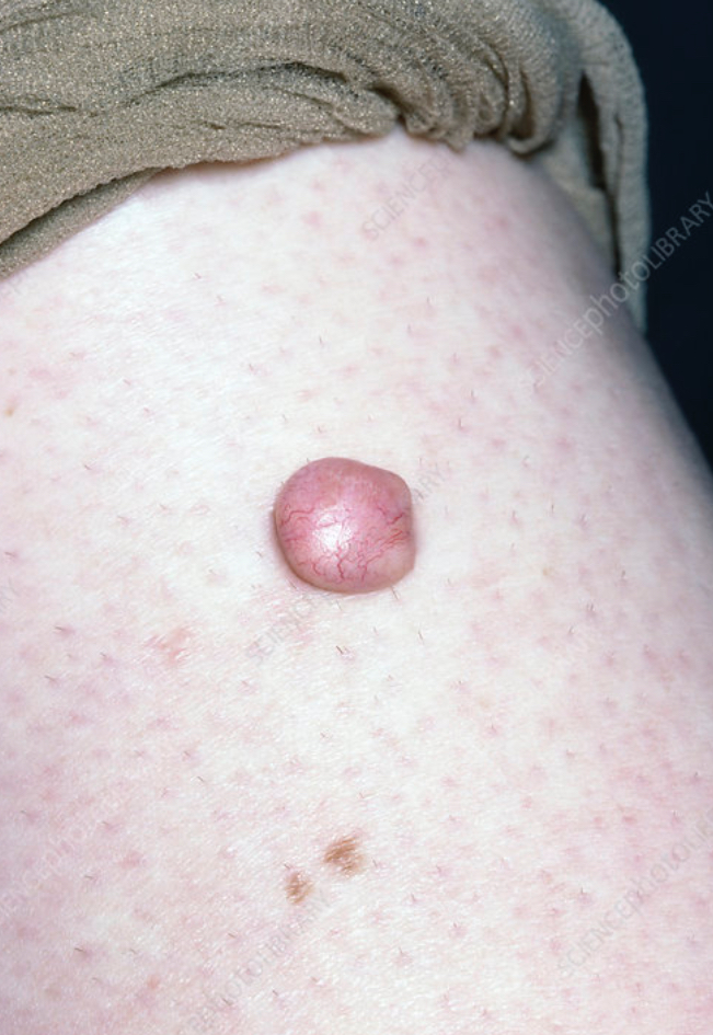 <p>Nodule</p>