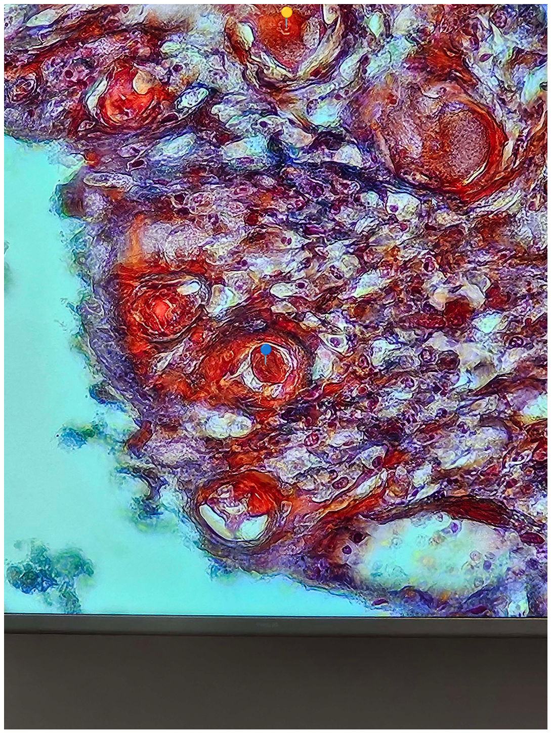 <p><strong><em>Entamoeba histolytica</em></strong></p><p>(Trofozoit)</p><p></p><p></p><p><strong>Parazytoza: </strong><em>Pełzakowica</em></p>