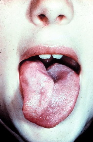 <p>atrophy of one side of tongue, deviation to ipsilateral side</p>