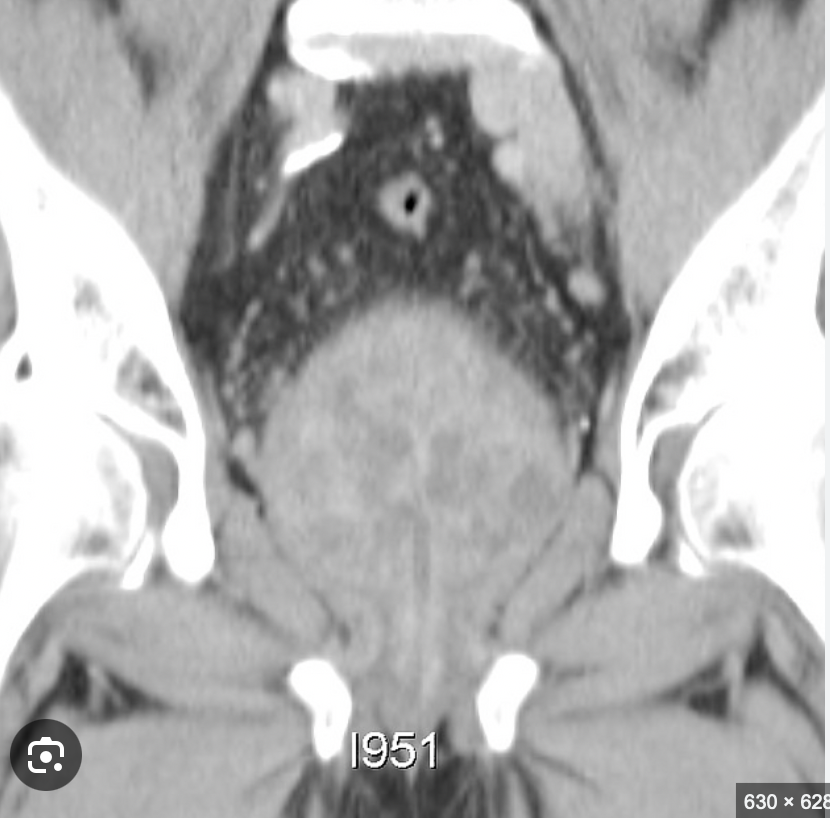 <p>bein prostatic hyperplasia&nbsp;</p><p><em>pathologic condition</em></p>
