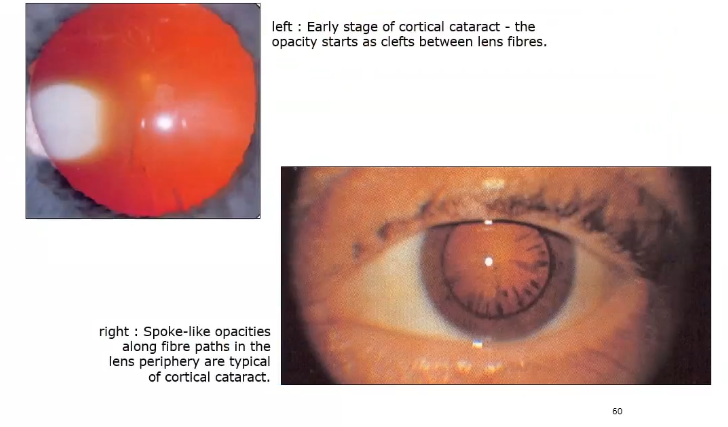 <p>cortical cataract</p>