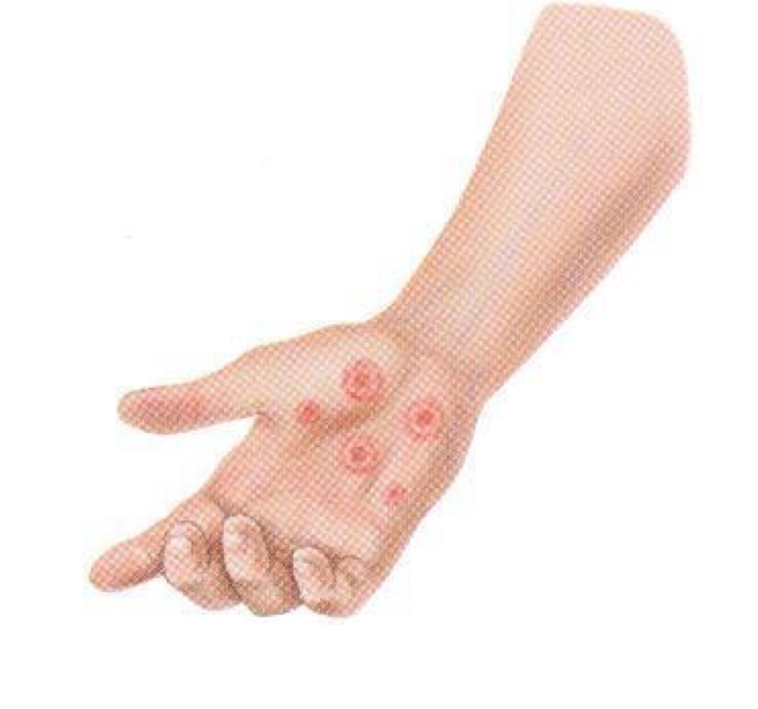 <p>what pattern of skin lesion is this? </p>