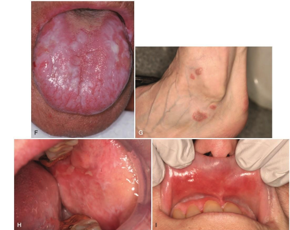 <p>what is the MOA of oral lichen planus (OLP)?</p>