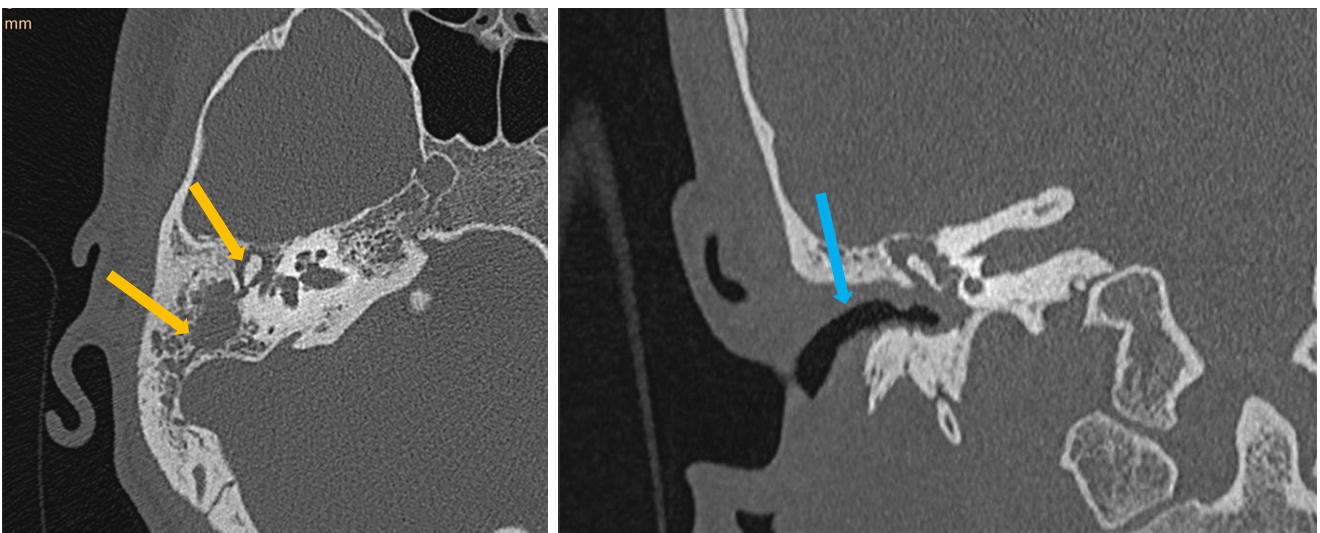<p>Patient history: Modality: ear pain and discomfort, poor hearing non-enhanced HRCT of the temporal bone </p><p>Region : temporal region, axial and coronal views </p><p>Radiologic sign: fluid-filled middle ear and mastoid cells (yellow arrows); bone erosion of the latter; thickened outer ear wall (blue arrow) </p><p>Diagnosis : recurrent otitis media</p>