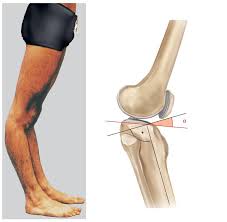 <p>Hyperextension of the knee</p>