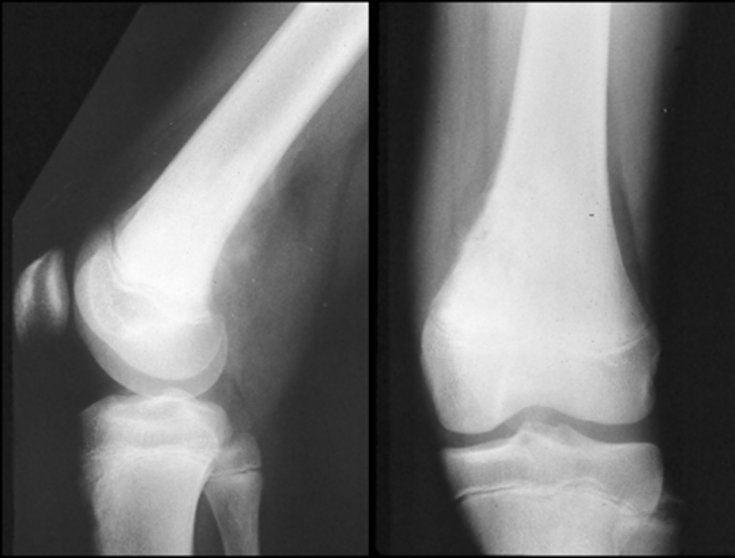 <p>ID type of osteosarcoma</p>