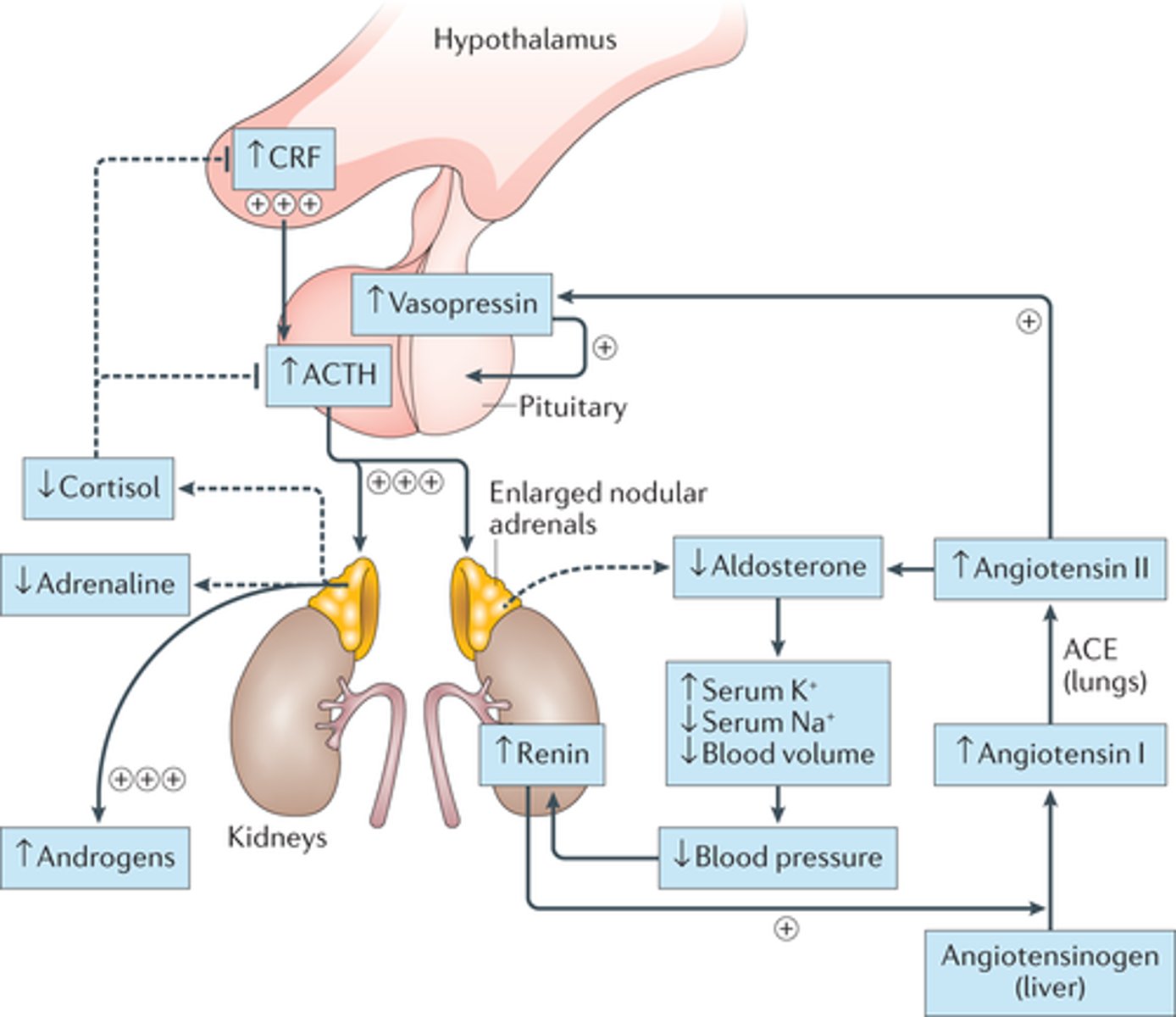 <p>Excessive androgens during gestation; common cause is congenital adrenal hyperplasia (CAH)</p><p>- Born with it, hyperplasia in adrenal cortex (Aldosterone - salt, Cortisol - sugar, Androgens - Sex, DAGA)</p>