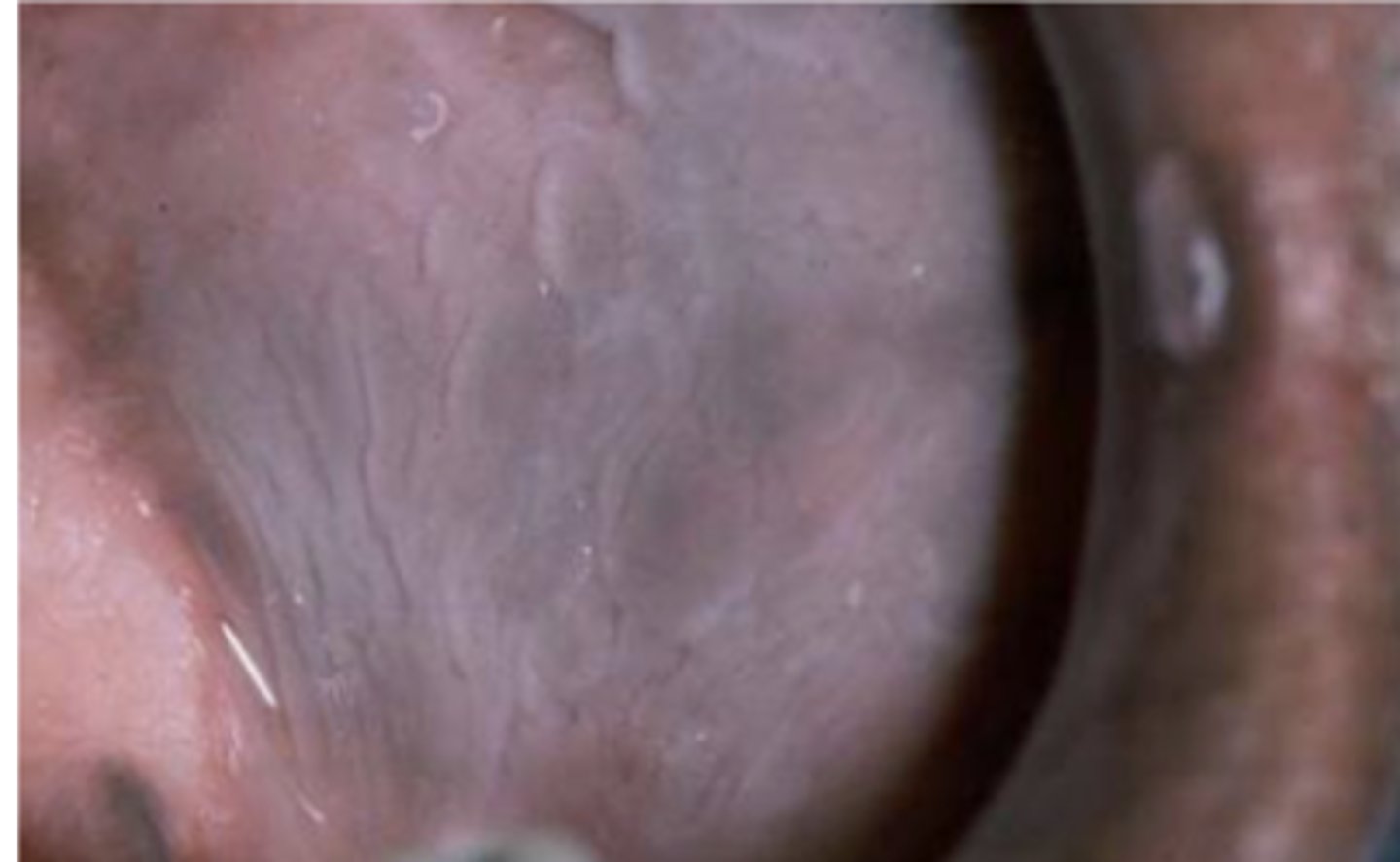 <p>what condition can be seen in this image?</p>
