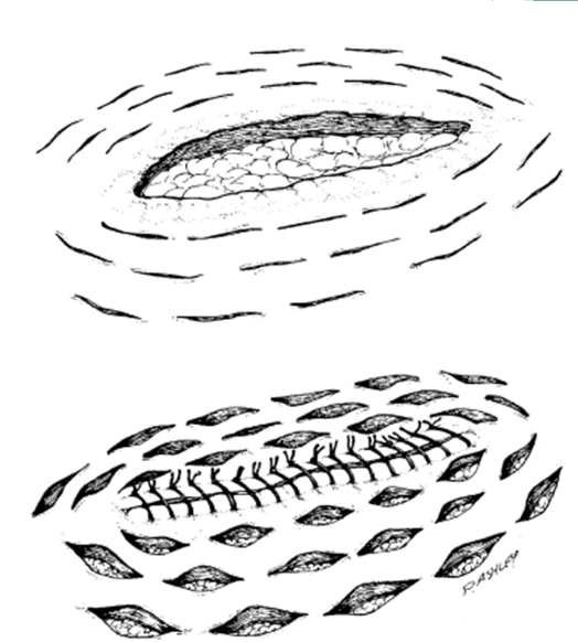 <p>close the primary wound and leave the relief incisions to heal by second intention </p>