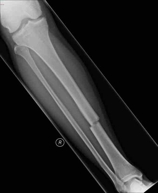 <p>Bone breaks but doesn’t pierce the skin</p>