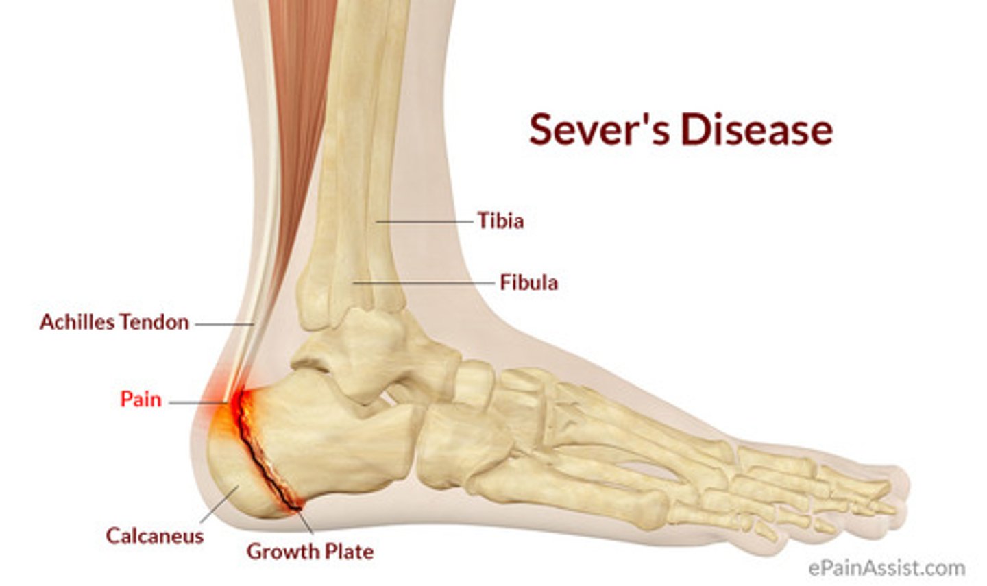 <p>Severs Disease</p>