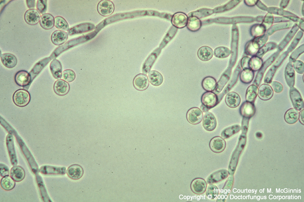 <p>An <strong>over-proliferation </strong>of the <strong>candida albicans </strong>microorganisms that naturally occur in the mouth</p>