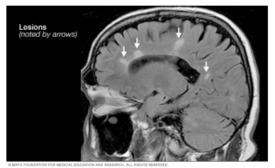 <p><strong>Young to middle</strong> aged adults</p><p>More common in <strong>females</strong></p><p>Often a presentation of m<strong>ultiple sclerosis</strong></p><p><strong>Inflammation </strong>results in <strong>demyelination </strong>of the <strong>optic nerve</strong>. Multiple rounds of such damage causes <strong>axonal loss and optic atrophy</strong></p>