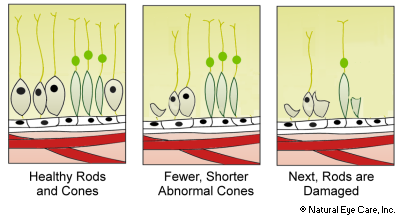 <p>As rods are lost, so too are cones (color receptive cells) because rods secrete substances that permit cones to survive, thus what change happens in our eyes? (aka cones also die as a result of rod loss)</p>