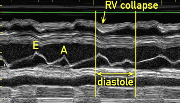 <p>early diastolic collapse of the RVFW</p>