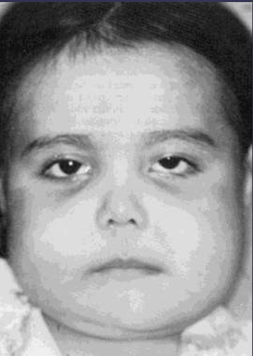 <ol><li><p>early childhood </p></li><li><p>chubby face </p></li><li><p>firm on palation, painless, normal mucosa </p></li><li><p>stops growing + regresses w/ age </p></li></ol><p></p>