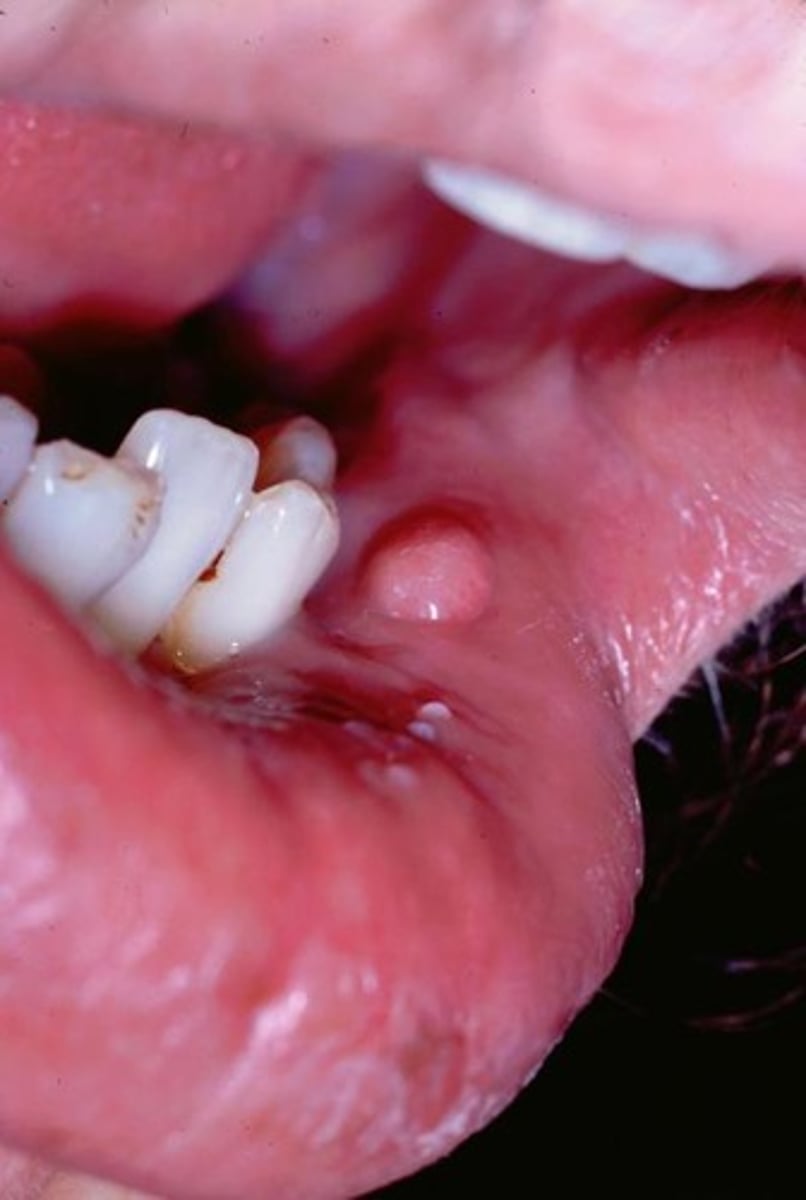 <p>-describing the base of a lesion that is flat or broad instead of stemlike</p>