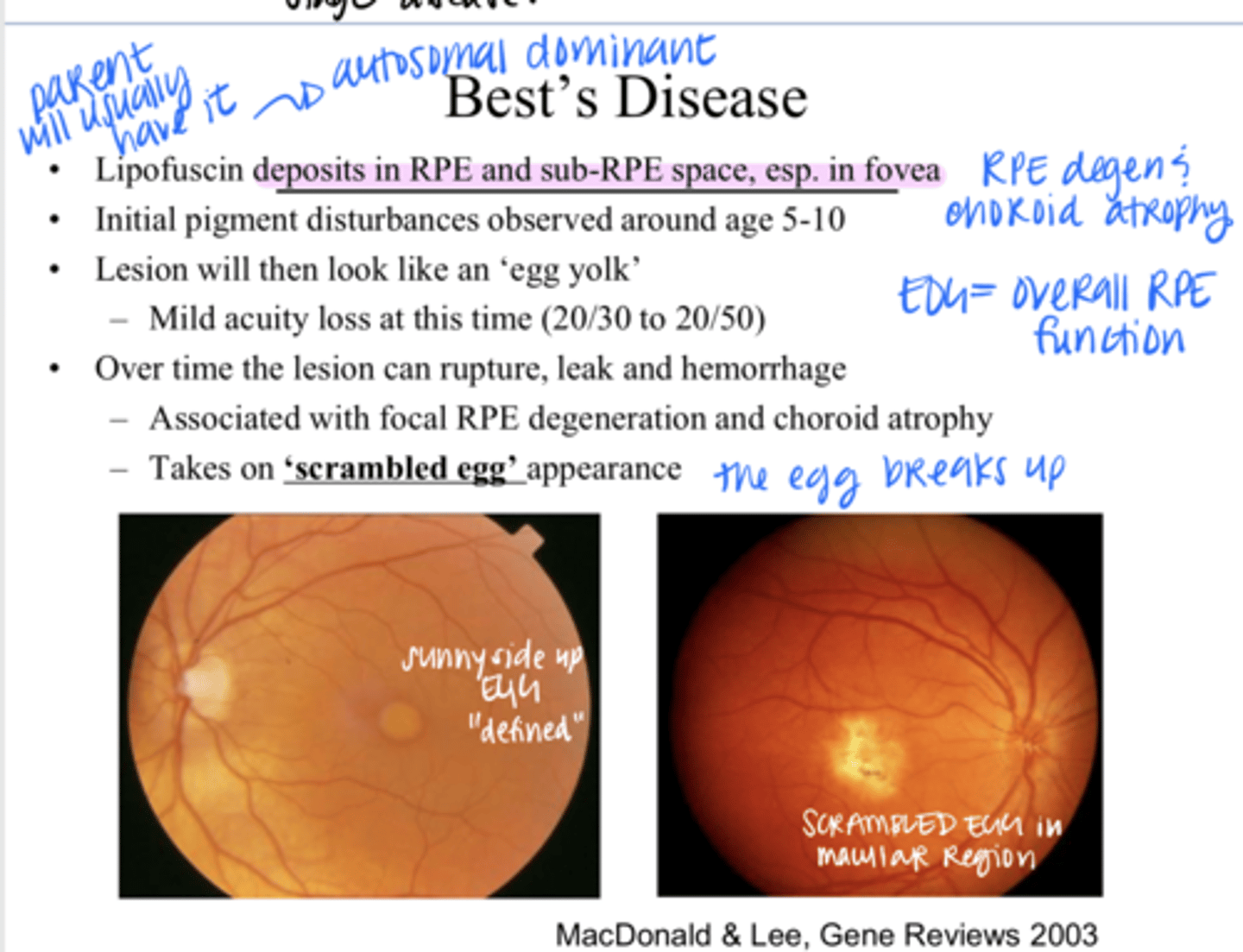 <p>What happens in Best's Disease?</p>