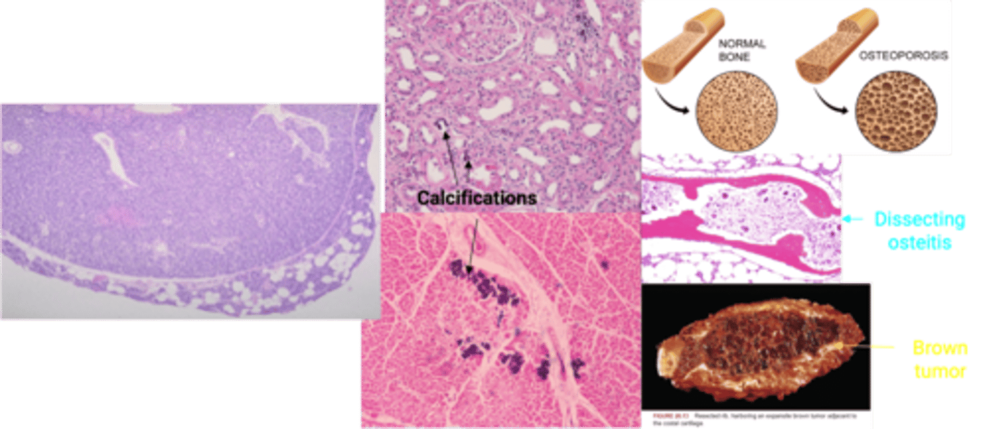 <p>Define Condition:</p><p>Single gland that is larger than the others (others smaller or normal size d/t feedback inhibition of increased serum Ca)</p><p>-Hx: More Common than Hyperplasia</p><p>-Path: Overactive gland, regardless of Ca level (PRIMARY)</p><p>&gt; Cyclin D1 gene rearrangement (next to PTH gene) --&gt; PROLIFERATES CHIEF CELLS</p><p>&gt; MEN1 mutation = 1/3 sporadic tumors</p><p>-Sx/PE:</p><p>&gt; STONES (Hypercalcemia)</p><p>&gt; Polyuria ("THRONE")</p><p>&gt; BONE Pain</p><p>&gt; Constipation/Muscle Weakness (GROANS)</p><p>&gt; AMS (PSYCH OVERTONES)</p><p>-Dx:</p><p>Histo</p><p>&gt; Nests and sheets of predominantly chief cells + fibrous capsule</p><p>&gt; Rim of normal tissue</p><p>Labs</p><p>&gt; Increased PTH</p><p>&gt; Increased Serum Ca</p><p>-Prog: (UnTx)</p><p>HPT</p><p>&gt; Osteoporosis (Low Bone Mass)</p><p>&gt; Dissecting Osteitis (More osteoclasts tunnel into center of trabecula)</p><p>&gt; BROWN "TUMOR" Bone Loss (MicroFx and Hemorrhage --&gt; Macrophages cause ingrowth of reparative fibrous tissue --&gt; osteoclasts, hemosiderin laden macrophages ==&gt; Mimic tumor)</p><p>&gt; Osteitis Fibrosa Cystica (Brown Tumor --&gt; Cystic Degeneration + Peritrabecular Fibrosis)</p><p>Hypercalcemia</p><p>&gt; Nephrolithiasis + Nephrocalcinosis</p><p>&gt; Metastatic calcification</p>