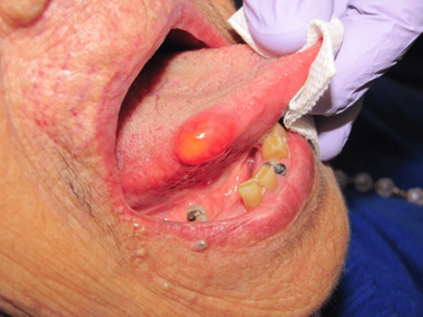 <p>Your patient presents will a yellow 1cm x 1cm nodule on the lateral border of the tongue. It looks mostly like a lipoma.</p><p>What type of biopsy should you take?</p><p>- Aspiration</p><p>- Cytology</p><p>- Incisional</p><p>- Excisional</p>