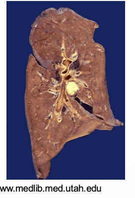 <p>Caseous necrosis (Form of Necrosis)</p>