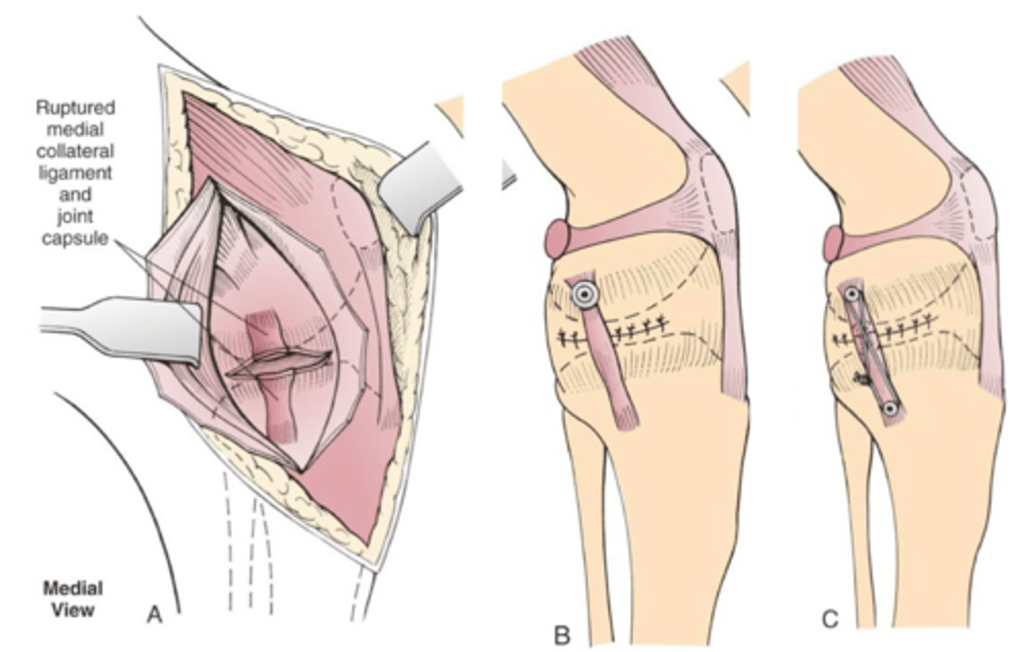 <p>explain general process of repair of medial collateral injury</p>